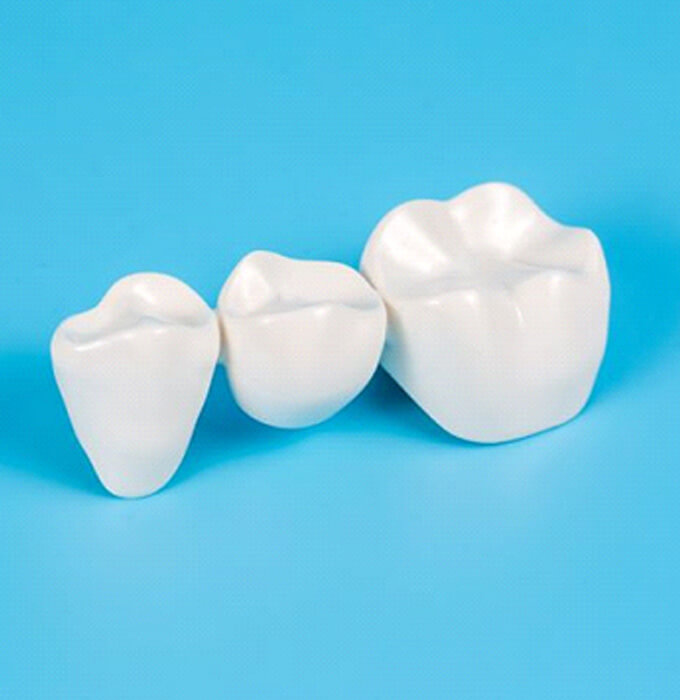 Three-unit dental bridge against blue background