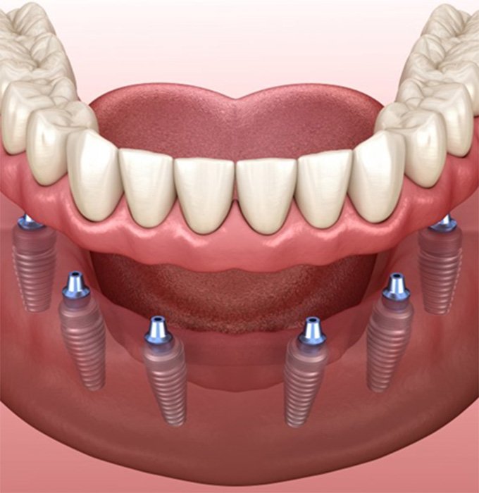 Digital illustration of implant dentures in Muskegon 