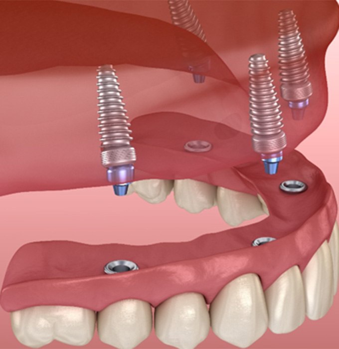 Digital illustration of upper implant dentures in Muskegon