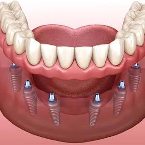 implant dentures in Muskegon for missing all teeth section