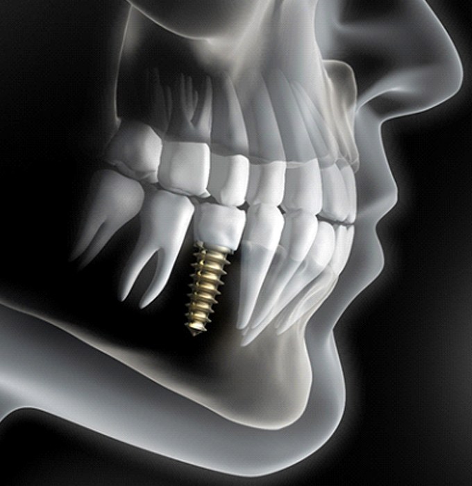Diagram of an integrated dental implant in Muskegon