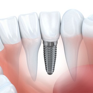 Dentists discussing cost of dental implants in Muskegon