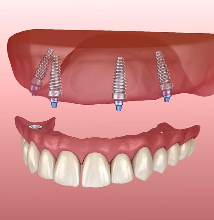 Man with All-on-4 in Muskegon, MI smiling with full dentures