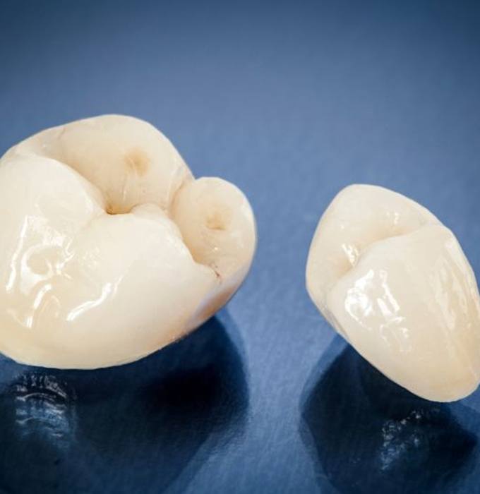Close-up of two ceramic dental crowns