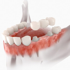 Illustration of traditional dental bridge being placed on teeth