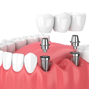 Illustration of three-unit dental implant bridge