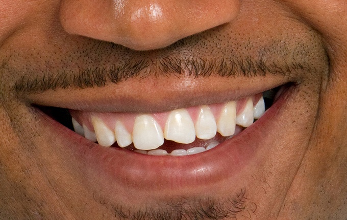 Smile with chipped front tooth