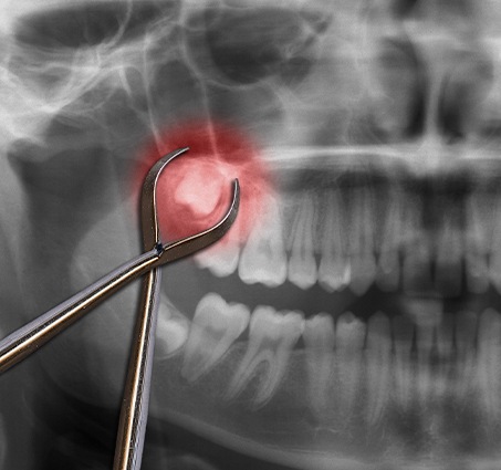 X-ray of smile with impacted tooth