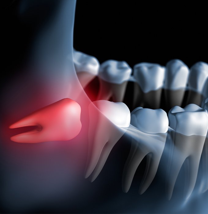 3 D rending of smile with impacted wisdom tooth