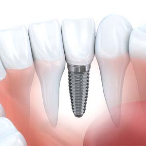 single dental implant in Muskegon for missing one tooth section