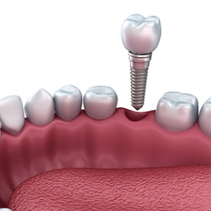 Diagram of dental implant hovering over gap in the mouth