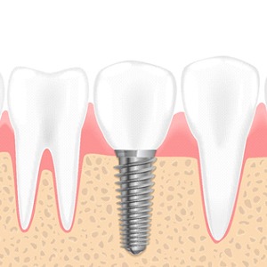 Diagram showing how dental implants work in Muskegon