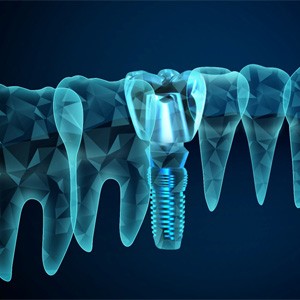 Illustration of dental implants in Muskegon, MI next to other teeth