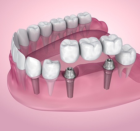 Animated smile with dental implant supported fixed bridge