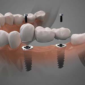 Diagram highlighting components of dental implants in Muskegon