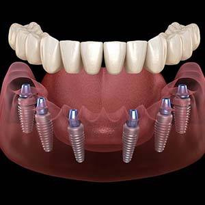 Diagram of a restoration hovering over integrated dental implants