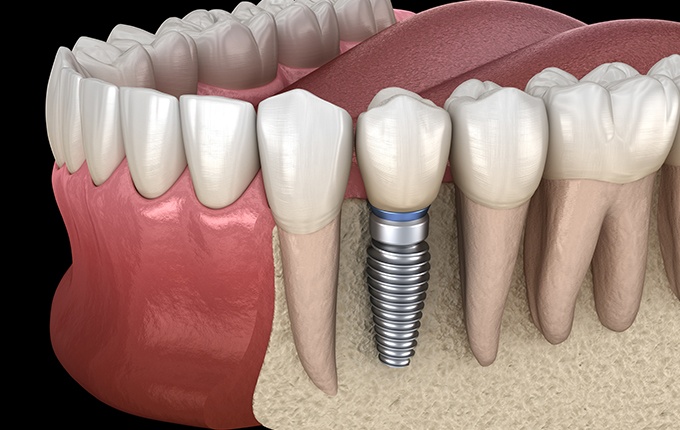 Animated smile with dental implant supported dental crown