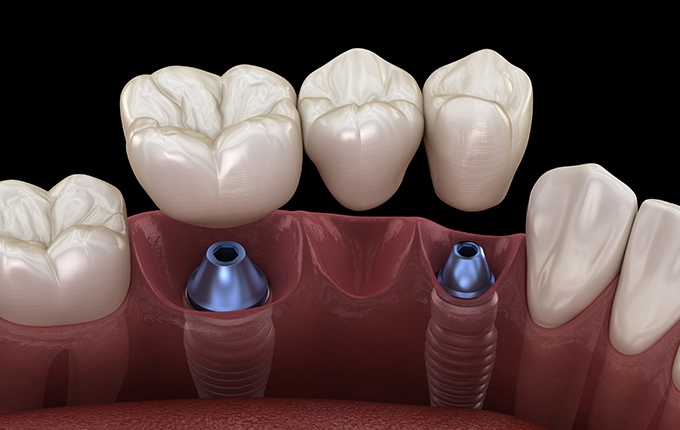 Animated smile with dental implant supported fixed bridge