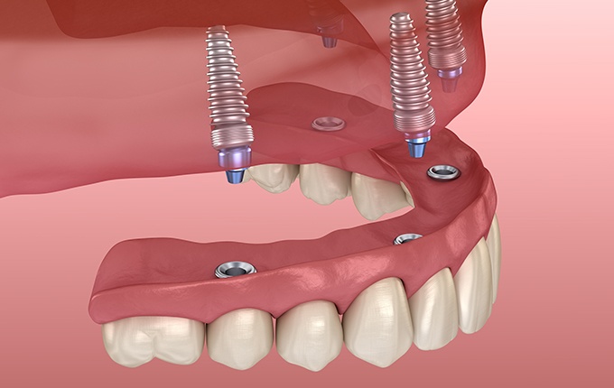 Animated smile with dental implant supported denture