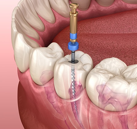 Animated root canal therapy procedure