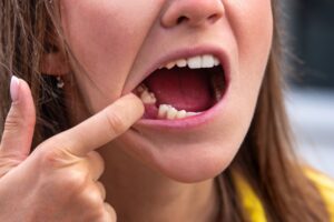 Woman with a missing back tooth