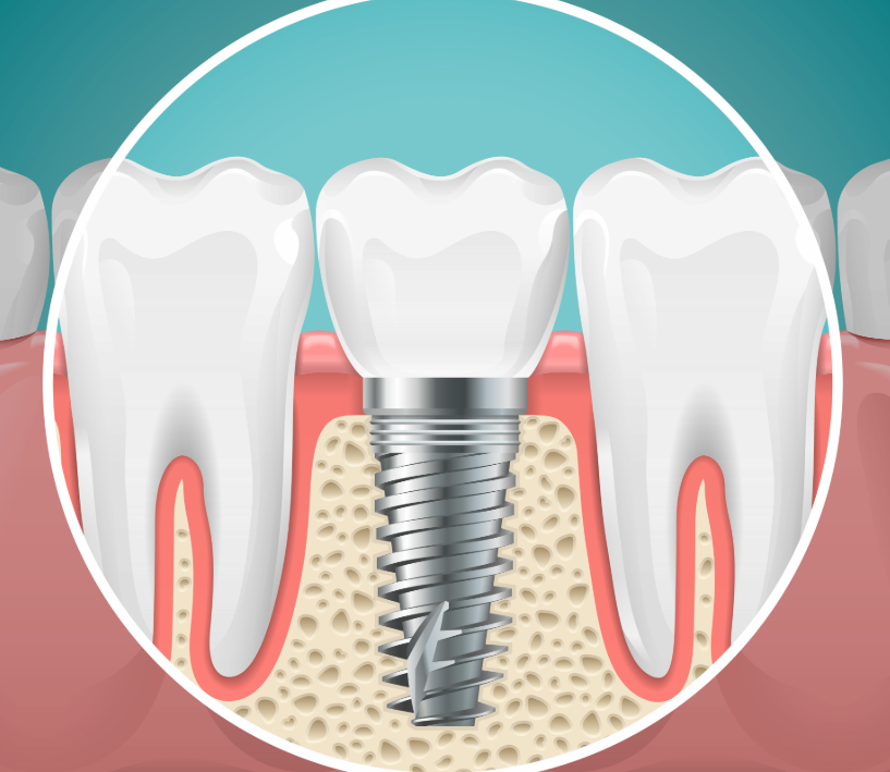 Illustrated cross section of a dental implant